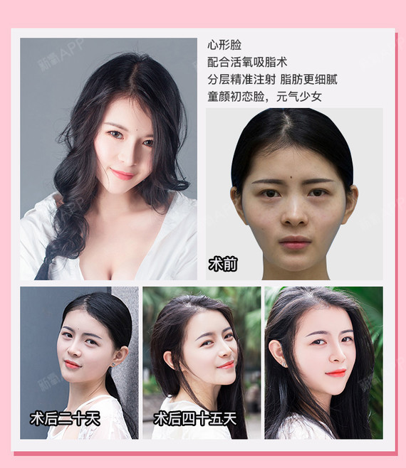 【自体脂肪面部填充】时光basic脂肪填充童颜术 成活率高 无充气感