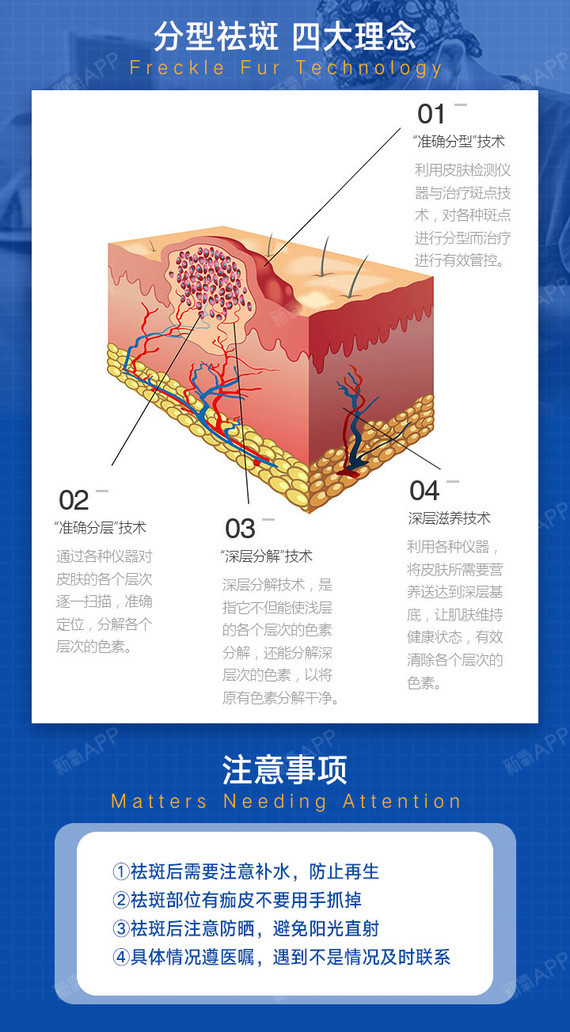 【激光祛斑】opt激光祛雀斑/去色斑精细祛斑/嫩滑肌肤/祛黄褐斑晒斑