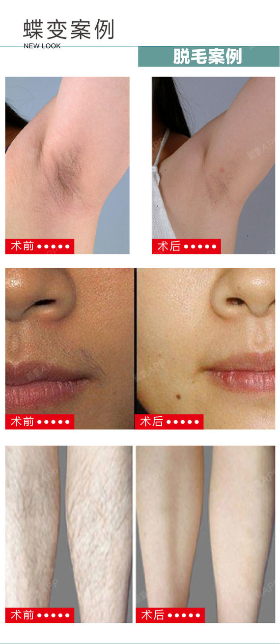 【激光脱毛】脱手脚毛 1次 ,冰爽无痛脱毛 拒绝毛糙 脱出白皙谈滑好