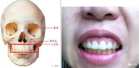 因為過長,向外凸的牙齒或牙床會拉長口周軟組織