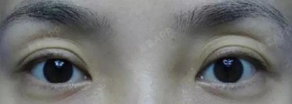 眼窝凹陷,看起来显老十岁?