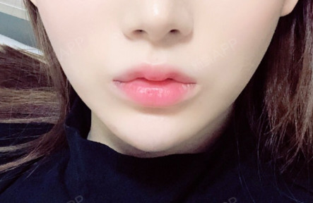 做了一个美美的花瓣唇,现在还是有点肿的,但是一点都不会痛