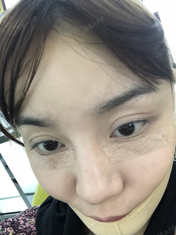 今天去拆线了,卧蚕的部位还是很肿,有点吓人,所以就_圈子-新氧美容