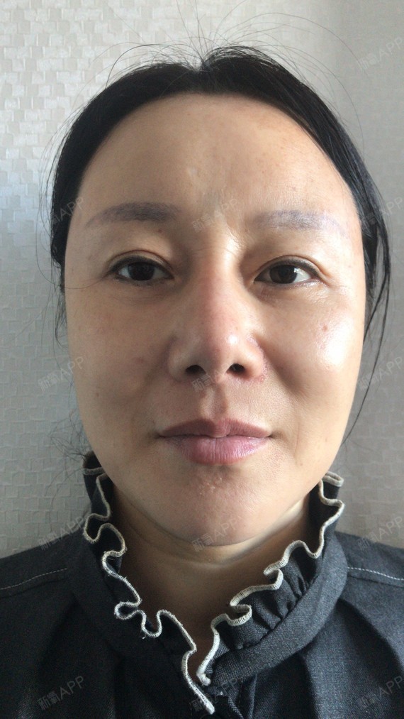 新氧- 只爱热巴呀 | 眼部 | 术后当自强 | 切眉术 | 上眼睑 | 北京