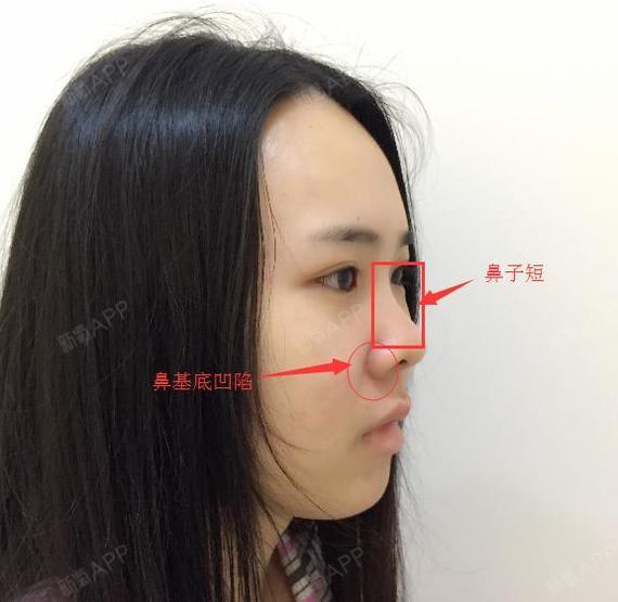 3,上唇超过鼻颏线2mm,下唇超过鼻颏线4mm;2,侧面观:鼻面角31°,鼻额角