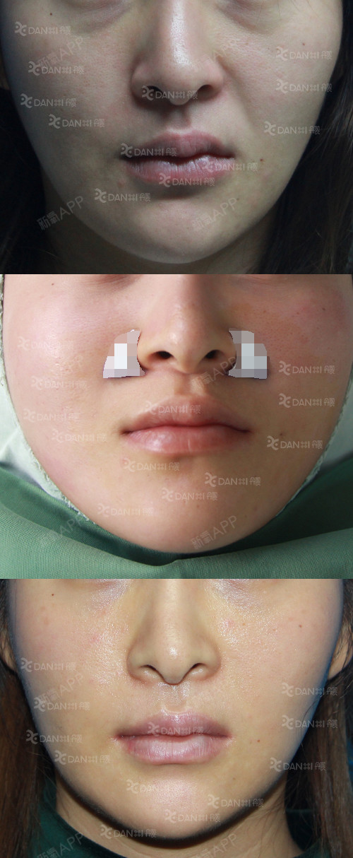 【鼻基底填充案例】