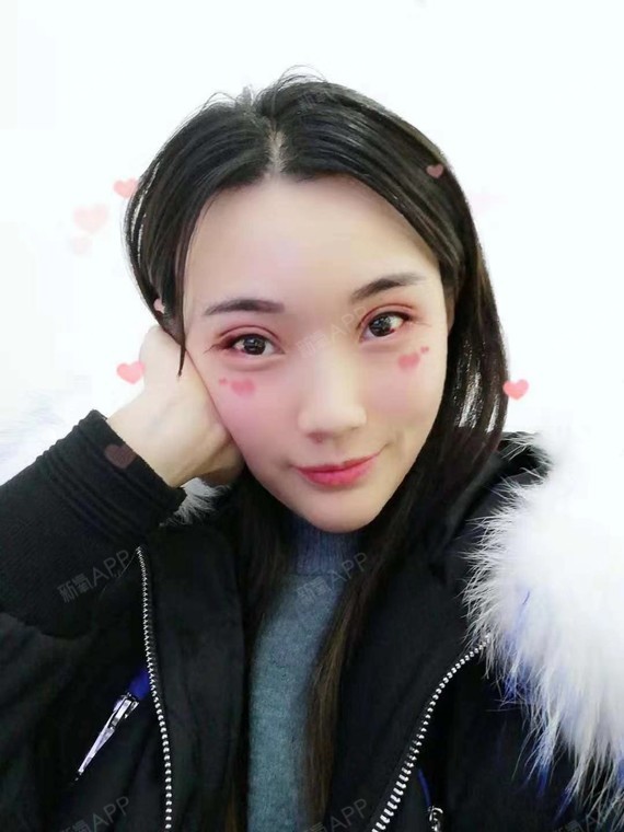菲林全切双眼皮 开外眼角术后第三天