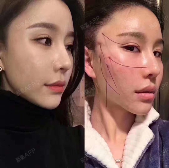 提升好不好_效果图_向日葵的花海埋线提升术后第10天_新氧美容整形