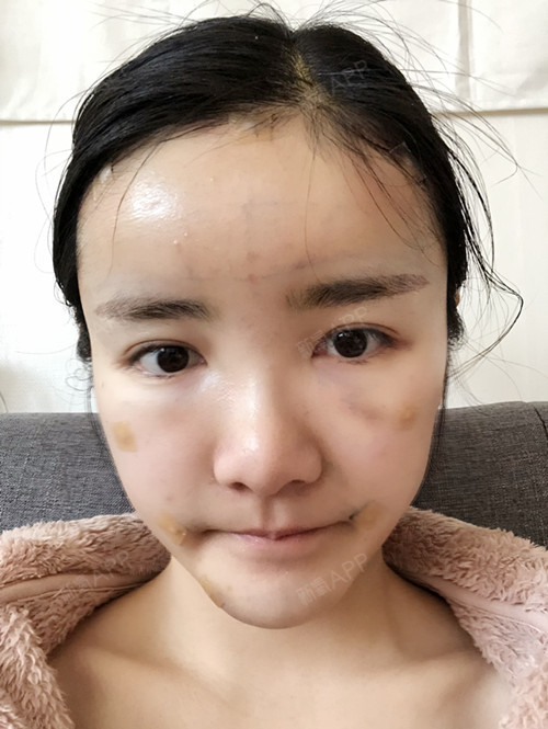 自体脂肪全脸填充好不好_效果图_咖啡爱自体脂肪全脸填充术后第0天