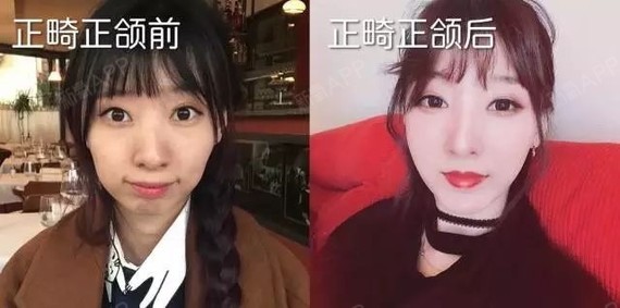 在影响嘴凸的原因上,除了上颌骨、下颌骨拯_圈