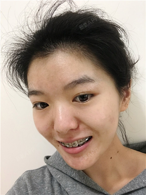 广州金属托槽矫正好不好_效果图_乖乖妹子没有钢牙金属托槽矫正术后第