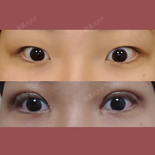 我本身就是单眼皮小眼睛,从小就觉得双眼皮很好看所以_圈子-新氧美容
