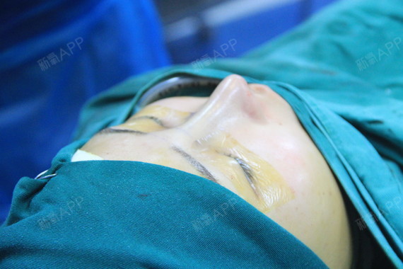 氧气yl689肋软骨隆鼻第1天美丽日记