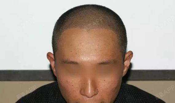 术后3年大面积植发震撼效果来袭!