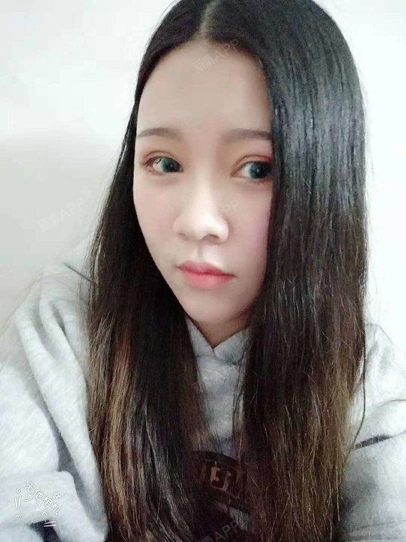 新氧- 清雅文丽 | 眼部 | 卧蚕 | 自体脂肪填充卧蚕 | 自体脂肪填充全