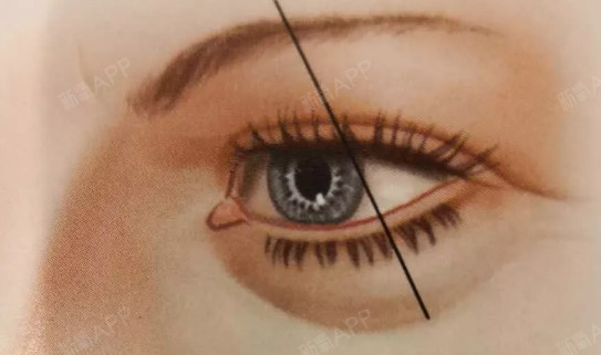 眼睑下至的手术方式