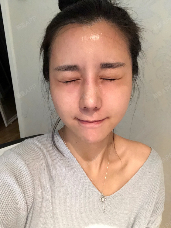人间的七月天水光针第7天美丽日记-新氧美容整形