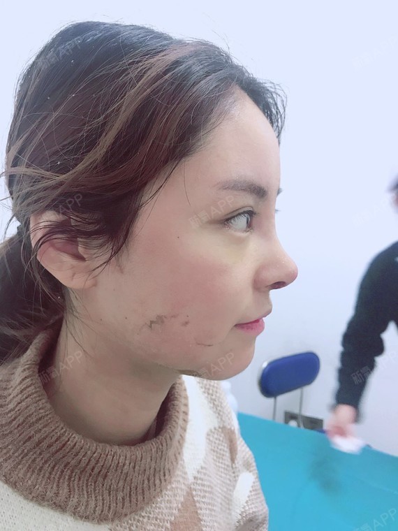 氧气ylfoo硅胶垫下巴第7天美丽日记