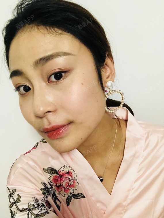来写篇日记啦,做的梨涡成形术,术后1天,苏医生做的_圈子-新氧美容整形