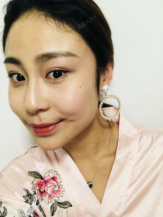 来写篇日记啦,做的梨涡成形术,术后1天,苏医生做的_圈子-新氧美容整形