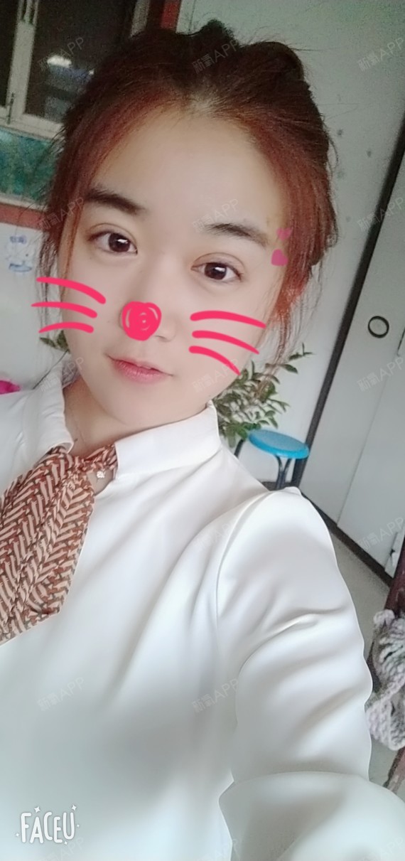 天津切开双眼皮好不好_效果图_卡卡卡的卡卡切开双眼皮术后第14天