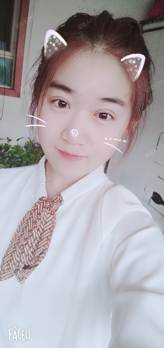天津切开双眼皮好不好_效果图_卡卡卡的卡卡切开双眼皮术后第14天