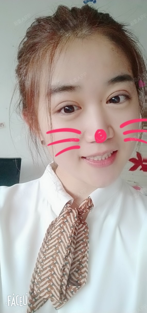 天津切开双眼皮好不好_效果图_卡卡卡的卡卡切开双眼皮术后第14天