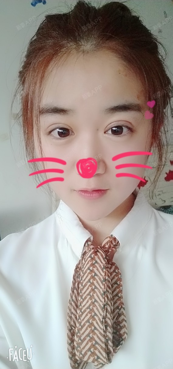 天津切开双眼皮好不好_效果图_卡卡卡的卡卡切开双眼皮术后第14天