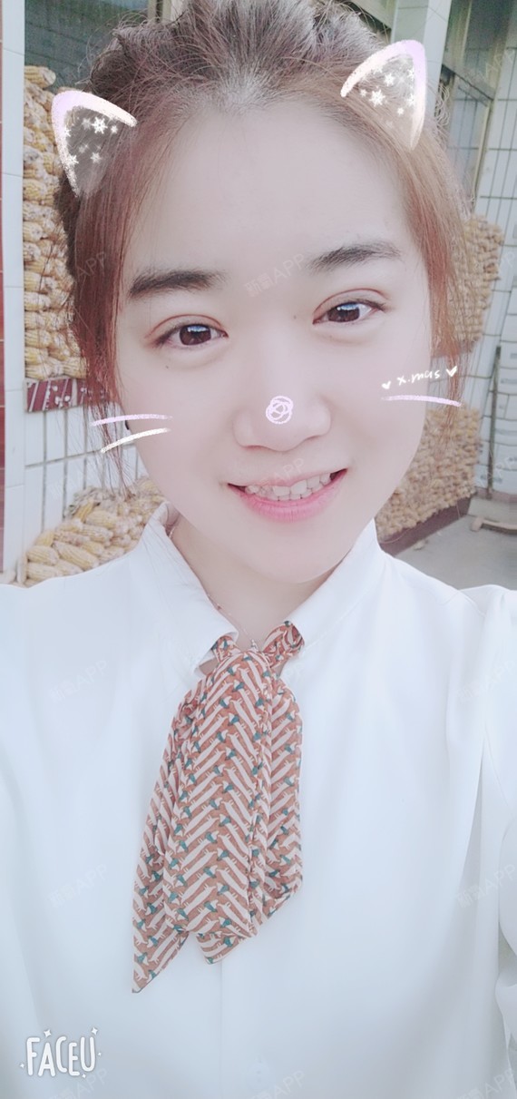 天津切开双眼皮好不好_效果图_卡卡卡的卡卡切开双眼皮术后第14天
