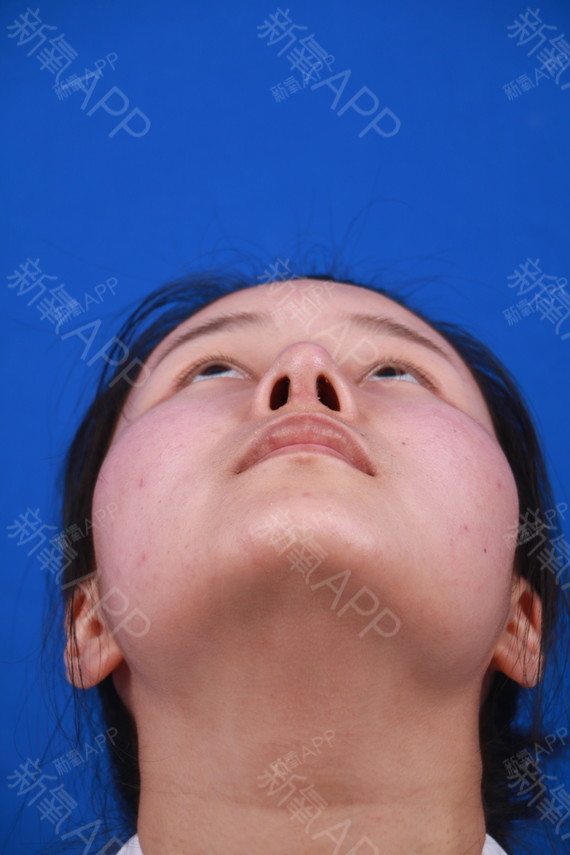 半个月的样子,能看到我鼻小柱的切口吗,摸起来能感觉_圈子-新氧美容