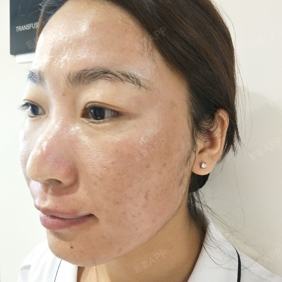 激光祛斑好不好_效果图_miss404激光祛斑术后第0天_新氧美容整形