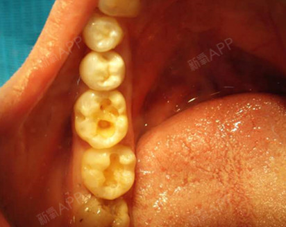 長時間沒來檢查牙齒牙齒居然出現了好多牙洞洗牙平常也不去了