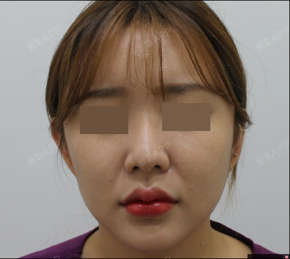 首尔特别玻尿酸丰唇好不好_效果图_氧气zbjzd玻尿酸丰唇术后第0天