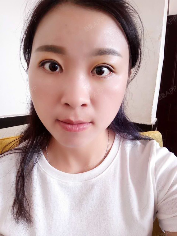 割完双眼皮一周了效果还可以也不是很肿