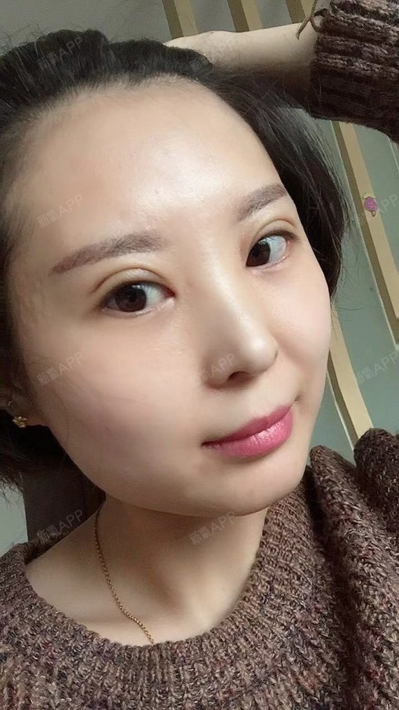 今天做完双眼皮手术已经一周啦,消肿很多,术后这几日_圈子-新氧美容