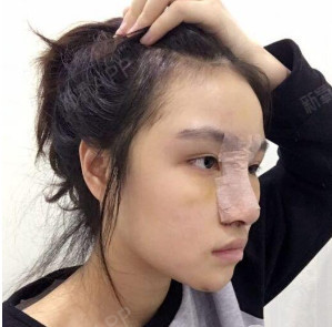 东莞鼻部多项好不好_效果图_氧气zcmtf鼻部多项术后第74天_新氧美容