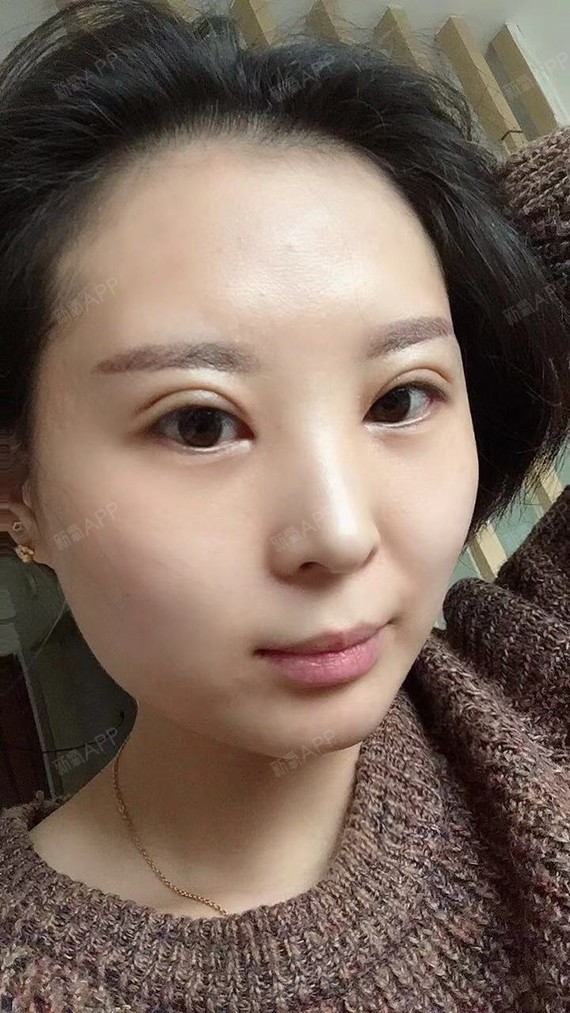 今天做完双眼皮手术已经一周啦,消肿很多,术后这几日_圈子-新氧美容