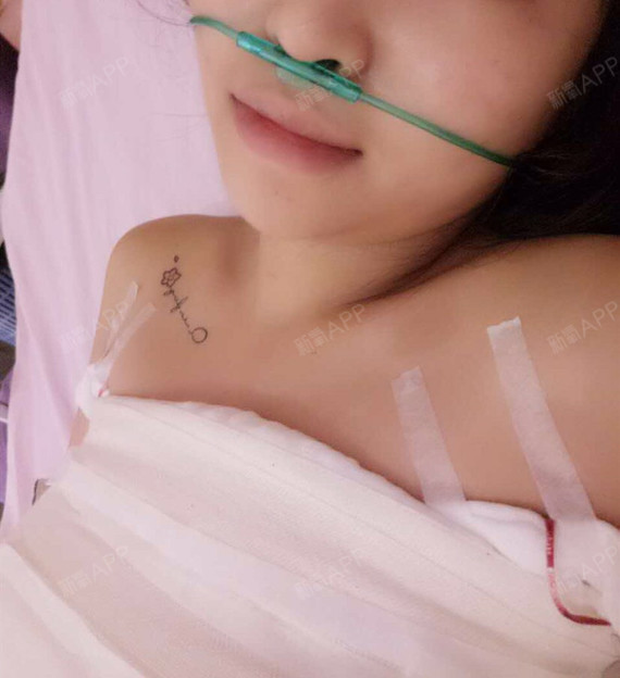 新氧- 爱吃火锅的萌萌 | 胸部 | 隆胸 | 假体隆胸 | 术后当自强
