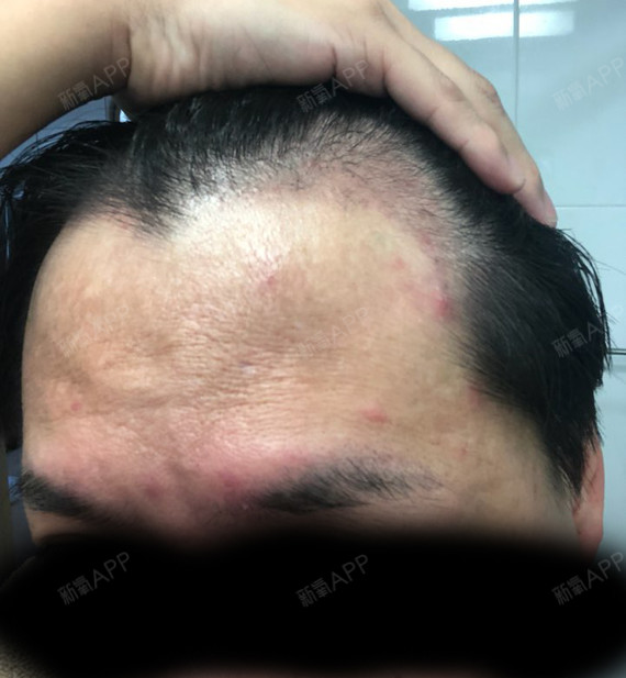 术后三个月反馈毛囊炎好的差不多了之前头发都掉光光了_圈子-新氧美容