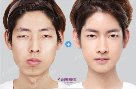 男士整形是什么鬼?必妩大揭秘!
