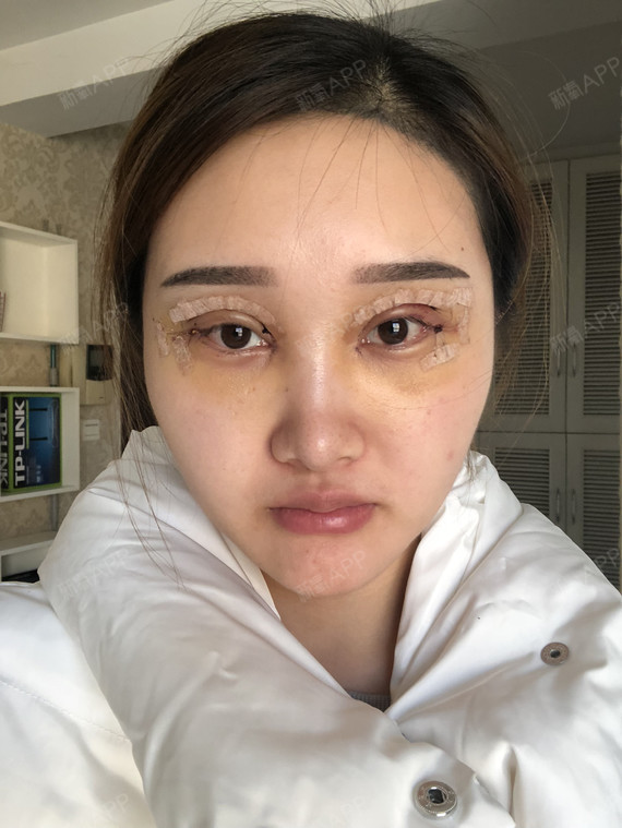 杭州艺星眼部多项修复内眼角手术5天