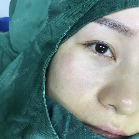 氧气ye8pq内切去眼袋第0天美丽日记