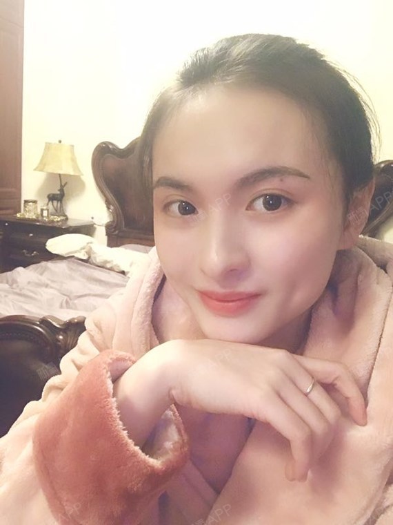双侧埋线酒窝术后半个月很满意很喜欢哦