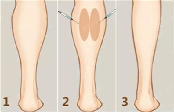 瘦腿,吸脂好還是打瘦腿針好?