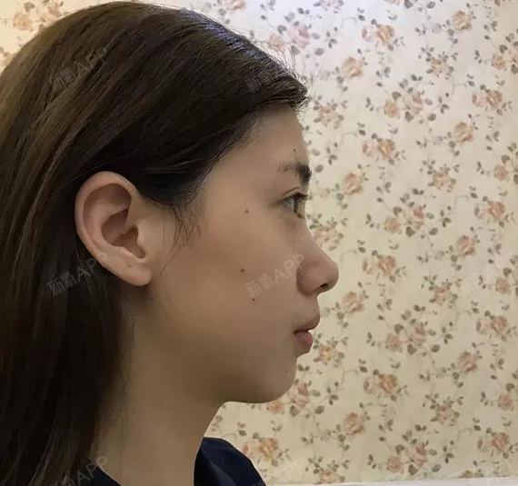 【鼻子长得丑是一种什么样的体验?30天,她逆袭