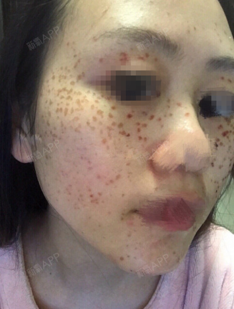 皮秒激光去除鸡皮肤(皮秒激光后怎么护理皮肤)