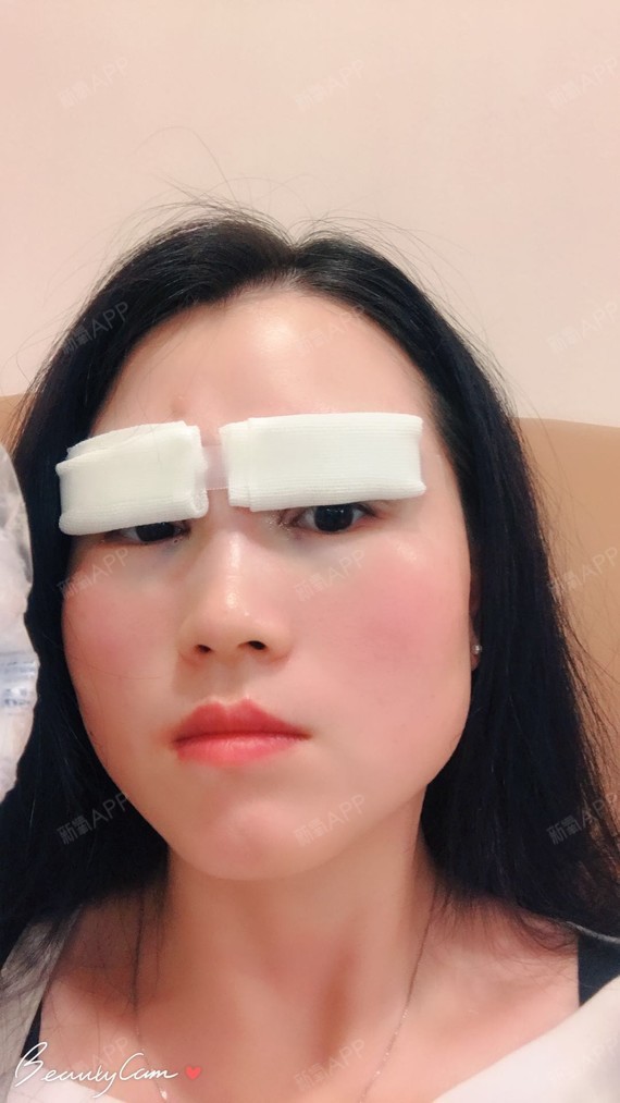 之前都没怎么注意,我睁眼的时候眉毛也是往上抬的,上睑下垂刚做完图片