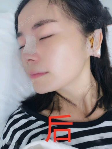 鼻子上包着纱布有点难受特别是不