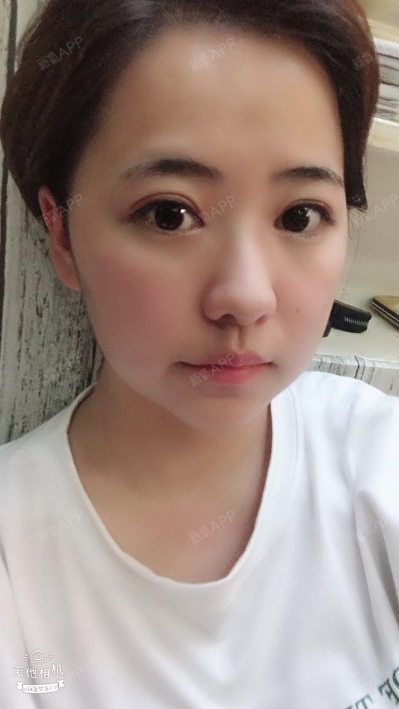 【武汉新至美-眼部多项-术后92天】拥有大眼睛双眼皮的第92天,开心是