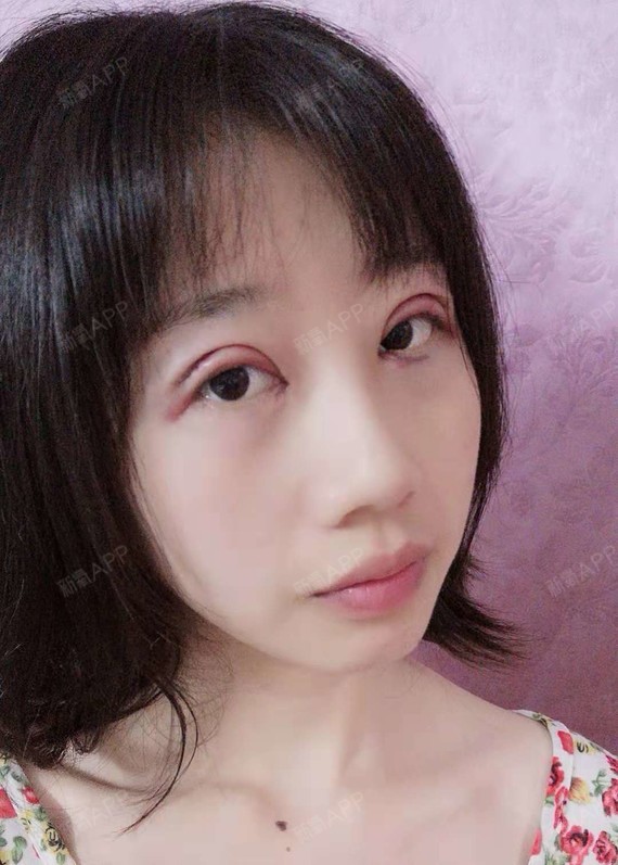 氧气ymzyl切开双眼皮第1天美丽日记